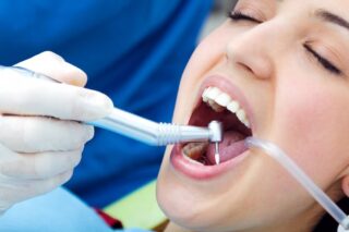 All you need to know about dental fillings